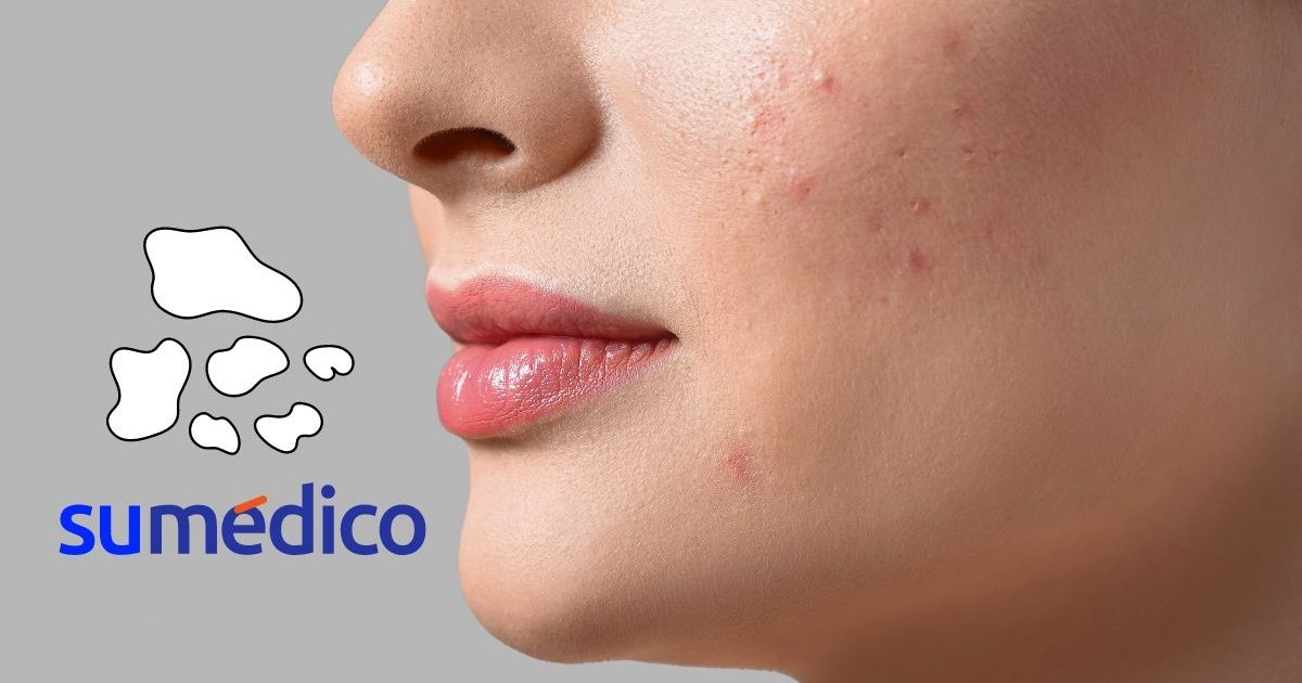 melas descubre sus sintomas causas y tratamiento